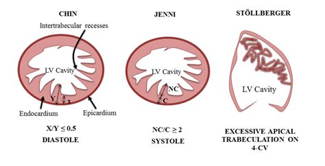 lv non compaction criteria.